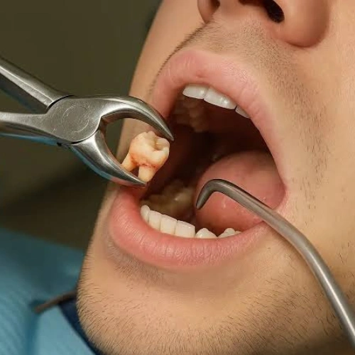 Wisdom Tooth Extraction
